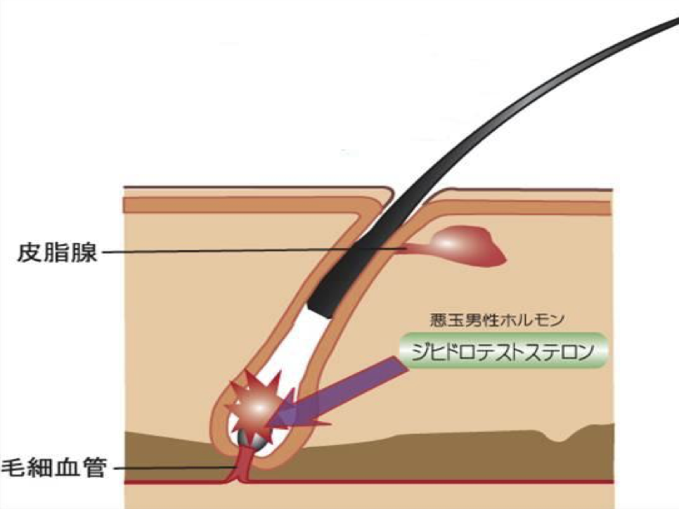 AGAのメカニズム、脱毛｜薄毛・発毛専門のスーパースカルプ岡崎