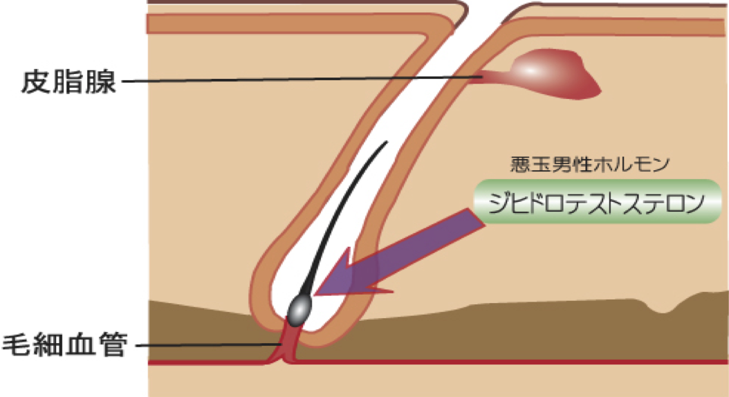 AGAのメカニズム、薄毛になる｜薄毛・発毛専門のスーパースカルプ岡崎